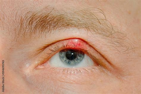 Folliculitis on eyelid Lash mites or eyelash mites (also known as Demodex folliculitis) are microscopic parasites found in the follicles on our faces