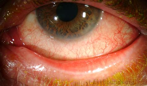 Folliculitis on eyelid Folliculitis describes infection that originates within a single hair follicle, usually caused by a bacterial infection with Staphylococcus aureus