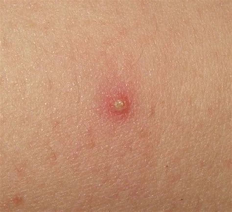 Folliculitis wikem  folliculitis staph ingrown follikulitis pubic follicle pimple pus gambe pimples folliculite inflamed