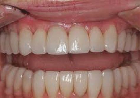 Full mouth replacement beaver dam ky  7:30AM - 3:00PM
