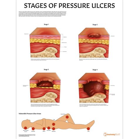 Gluteal cleft pressure ulcer  Healing pressure ulcer of other site, stage 3