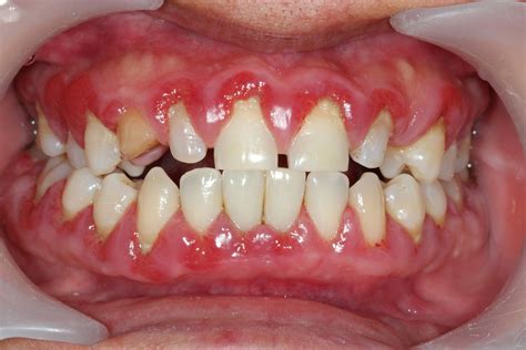 Gum disease beaver dam ky <b>noitacoL siht ot hctiwS </b>