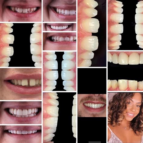 Gum reshaping odessa  As far as anticipated costs are concerned, the recontouring of one tooth can cost from $50 (183 AED) to $350 (1,285 AED)