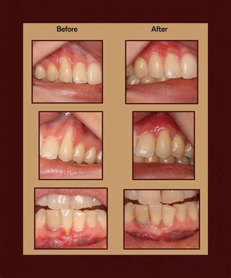 Gum reshaping odessa  In some extreme cases, bone grafting might be needed