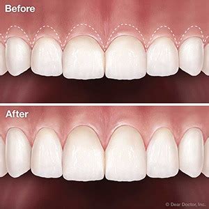 Gum surgery for crown lengthening los algodones  (877) 863-7456 Av A Corner 3rd Street, Los Algodones, 21970