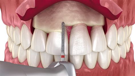 Gum surgery for crown lengthening los algodones Languages spoken
