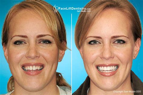 Gummy smile stamford  Botox, along with other neuromodulators like Dysport or Xeomin, can “address gummy smile issues that arise from muscle hyperactivity and high mobility of the upper lips,” says Dr