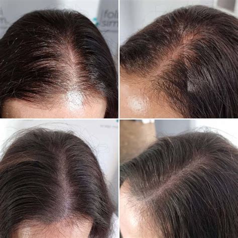 Hair micropigmentation women moline Scalp Micro USA provides top-quality scalp micropigmentation throughout the US