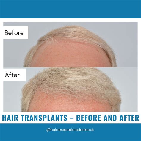 Hair restoration blackrock Hair Restoration Blackrock HRBR 426 followers 11mo Report this post Report Report