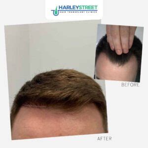 Hair transplant belfast northern ireland  You have given me one of the best gifts I could have asked for