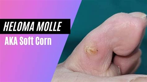 Heloma millare  Soft corns on feet occur between the toes, although you can get hard corns there too