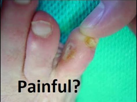 Heloma molle treatment  Often the patient will have a slightly shorter 5 th toe or a previous fracture that causes the toe to be more prominent