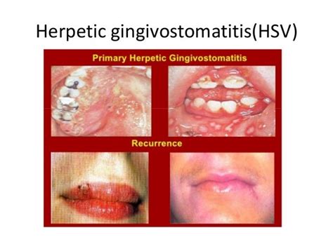 Herpangina vs gingivostomatitis  Herpangina mempunyai karakteristik berupa vesikula pada bagian belakang rongga mulut dan palatum, sepanjang faring yang meradang