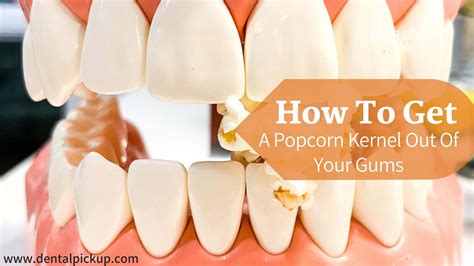 How to get a popcorn kernel out of your gums  It’s a great shape to slip between our gums and teeth when we chew popcorn kernel hulls