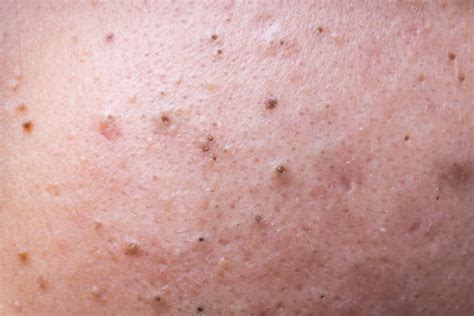 How to get rid of blackhead on inner thighs Hello, I was just passing through and noticed that someone said that they have boils and the dr said it was because you were black