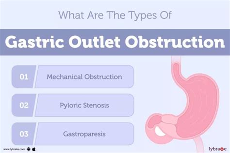 Icd-10 gastric outlet obstruction  The