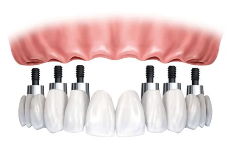 Implant dentures woodinville wa  If you are missing all of your teeth, or need a full arch top or bottom restoration, an implant-supported full bridge or full denture may be a great choice