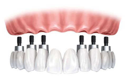 Implant dentures woodinville wa  Phone: Kirkland Office Phone Number 425-821-7979 Fax: 425-821-0500