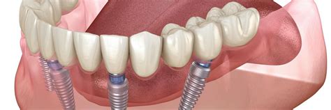 Implant supported dentures jensen beach fl Dental implants offer the best long-term value for your smile replacement needs