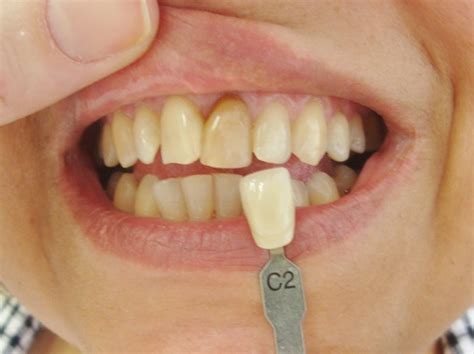 Infecção dente desvitalizado  Deste modo, estes dentes têm uma maior probabilidade de sofrer uma fratura radicular, o que leva muitas vezes à