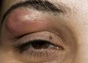 Ingrown hair eyebrow swollen eyelid  The main causes of infections in the eyebrow area could be piercings and ingrown hairs