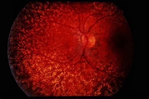 Intermediate dry amd icd 10 32 became effective on October 1, 2023