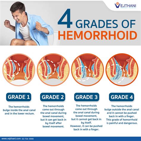 Internal hemroids  They are further graded on a 4-point scale 3: Grade I—Visible hemorrhoids that do not prolapse