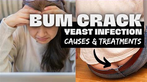 Intertrigo bum crack Intertrigo is a raw, red rash that develops inside your skin folds