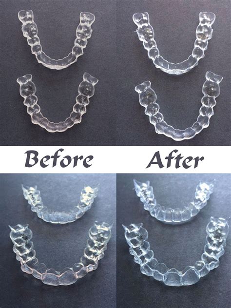 Invisalign greystanes  When worn as directed, the clear Invisalign® trays should gradually move the teeth into a straighter, better-aligned position