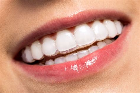 Invisalign summerbrooke  It usually comes in a series and each consecutive aligner moves teeth ever so slightly towards your goal of complete alignment