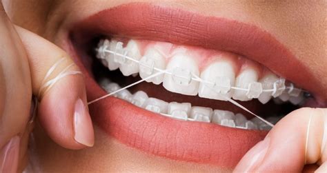 Invisible braces merrylands Invisalign invisible braces take roughly the same amount of time as traditional braces—between 12-24 months for most teen or adult patients