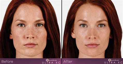 Juvederm stratham  To set up a consultation or appointment, Click here