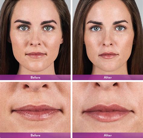 Juvederm volbella xc bradenton florida Then there’s the Juvéderm suite, which includes (from thinnest to thickest) Juvéderm Volbella XC, Juvéderm Ultra XC, and Juvéderm Ultra Plus