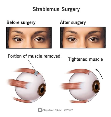 Krp eye surgery  Search Health Library