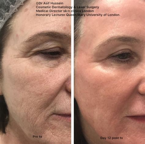 Laser resurfacing snoqualmie  425-374-1521