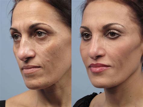 Laser skin resurfacing treatment stark county Popular laser skin resurfacing treatment areas include around the eyes or mouth, full face, neck, chest, and hands