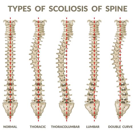 Levoconvex thoracolumbar scoliosis : scolioses) is a condition in which a person's spine has a abnormal curve
