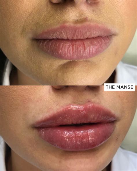 Lip fillers lincoln ne  Mitchell Henry offers the latest in FDA approved injectable products for wrinkle reduction and volume enhancement