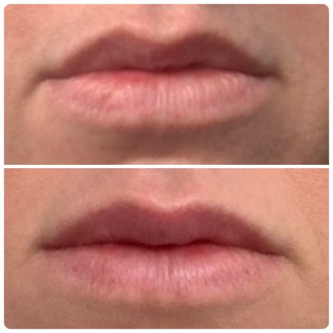 Lip flip hillcrest  The result is a more dramatic enhancement that can last up to a year