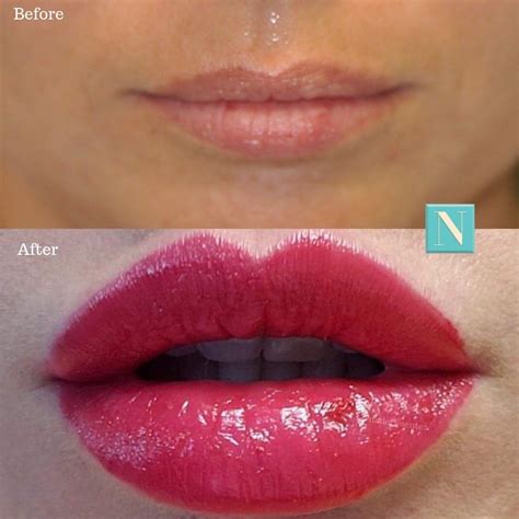 Lip injections ojai "Generally speaking, dermal fillers fall into two main categories: hyaluronic acid filler, which is most commonly used for lip injections, and biostimulators," explains