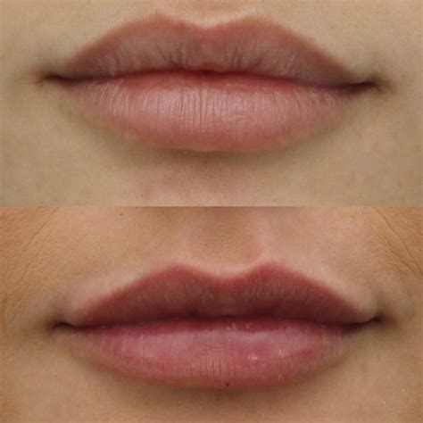 Lip injections omaha The most commonly reported side effects with JUVÉDERM ® injectable gels were redness, swelling, pain, tenderness, firmness, lumps/bumps, bruising, discoloration, and itching