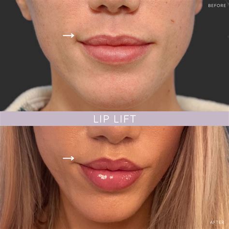 Lip lift omaha  First and foremost, it shortens the lip