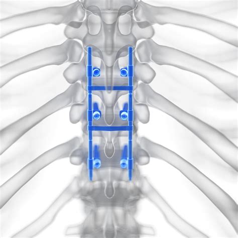 Lumbar fusion in skegness  Mayo surgeons can perform spinal fusion from the back, front or side of the spine and have access to the newest varieties of bone-fusing materials