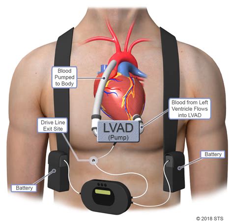Lvac sahara photos A left ventricular assist device (LVAD) is implanted in the chest