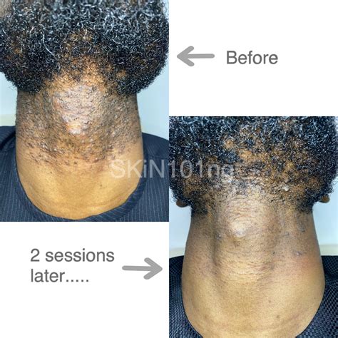 Makeo laser hair reduction  improves the appearance of stretch marks