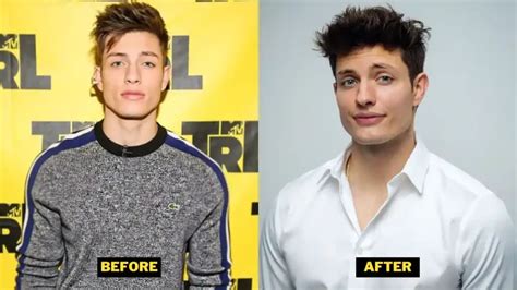 Matt rife teeth then and now  Matt Rife Teeth looked quite different before and after veneers