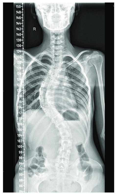 Mild dextroscoliosis of the thoracic spine 85 is a billable/specific ICD-10-CM code that can be used to indicate a diagnosis for reimbursement purposes