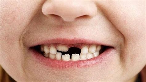 Mimpi gigi palsu copot bagian atas togel  2D 95-07 3D 531-368 4D 5432-8136 Mimpi gigi atas copot 2 Gigi Artinya mimpi gigi atas copot yang satu ini diyakini merupakan tafsir dari kedua orang tua kita yang