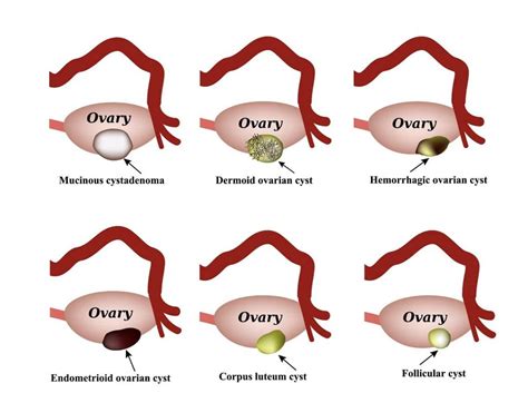 Mucus cysts southlake  Other common symptoms include: Swelling and tenderness in the affected area