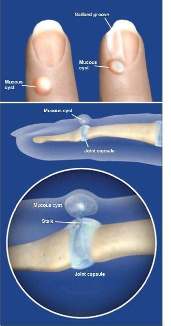 Mucus cysts southlake  Size of the displaced epithelial fragment is a crucial factor for the development of the mucous cyst